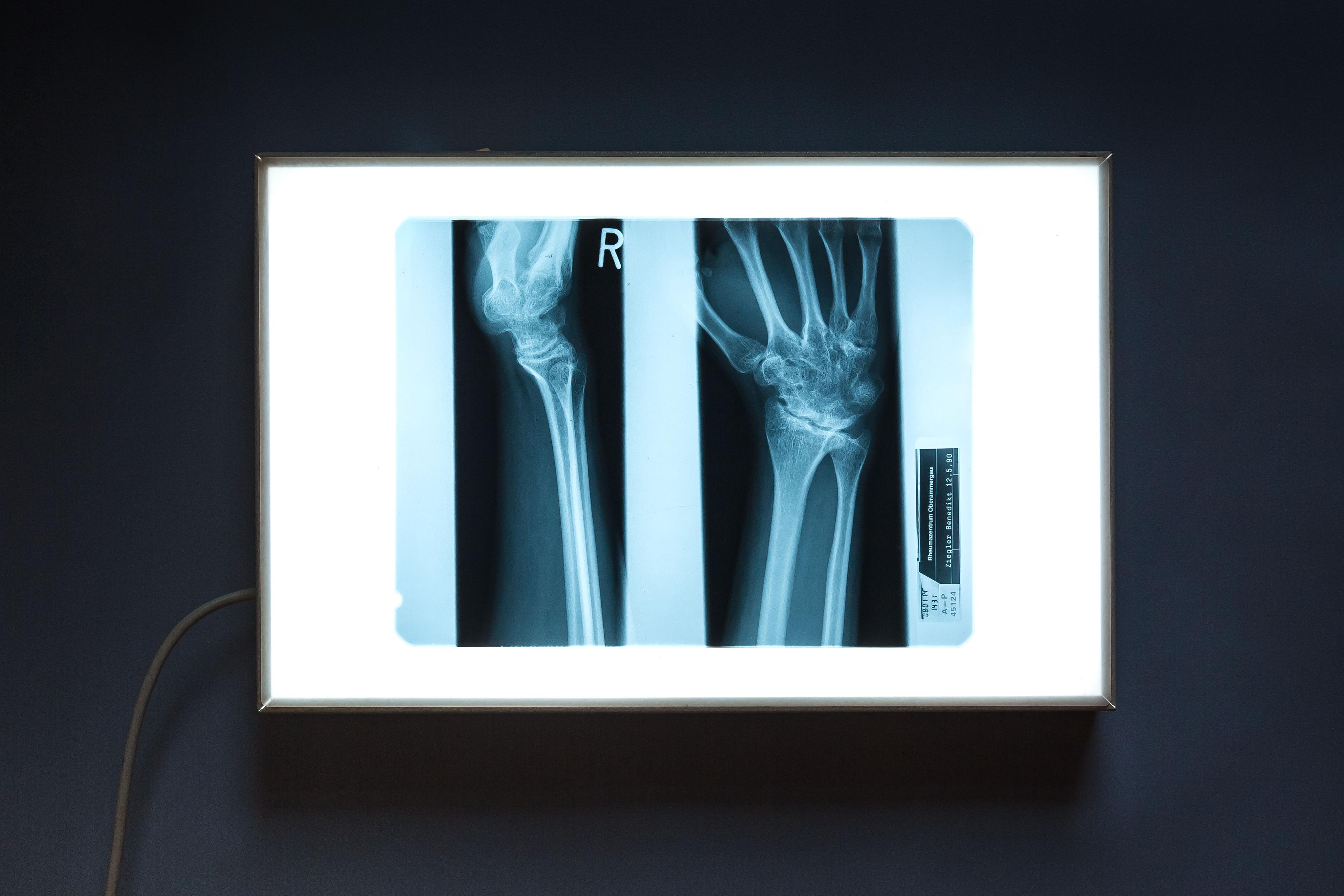 Zwei Röntgenaufnahmen. Ein Arm und eine Hand.