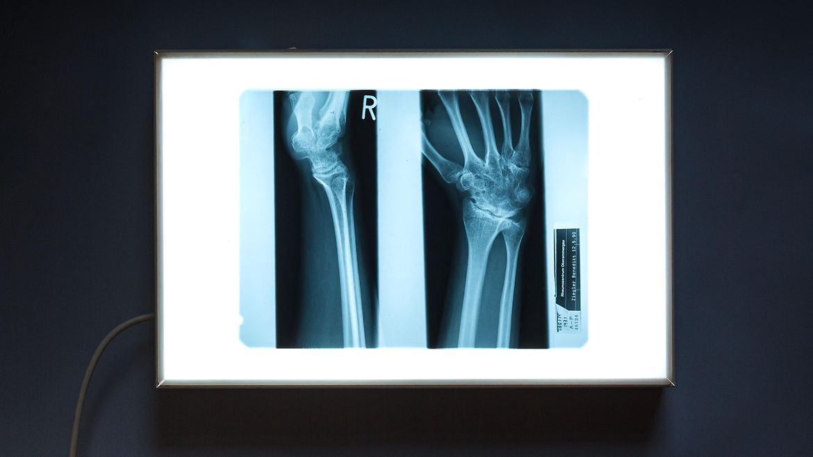 Zwei Röntgenaufnahmen. Ein Arm und eine Hand.